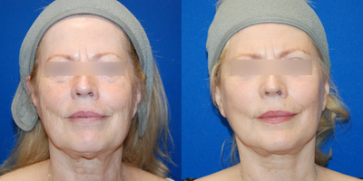 Facelift before and after photo