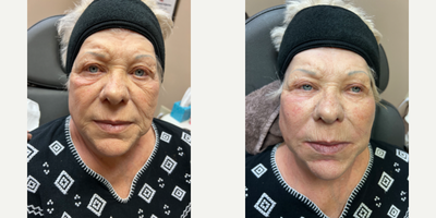 Liquid Facelift before and after photo
