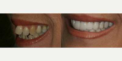 Dental Implants before and after photo