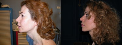 Facelift before and after photo