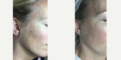 IPL before and after photo