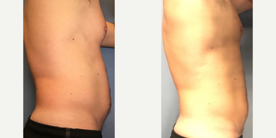 SculpSure before and after photo