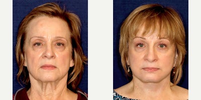 Deep Plane Facelift before and after photo
