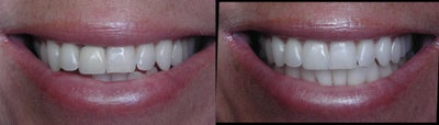 Dental Crown before and after photo