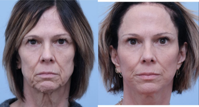 Facelift before and after photo
