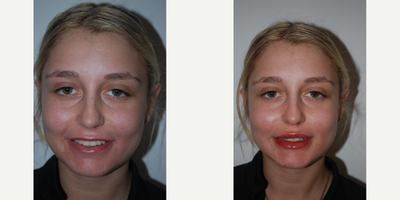 Lip Fillers before and after photo