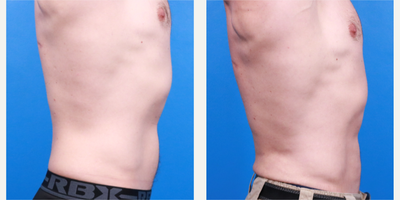 Liposuction before and after photo