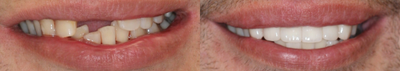 Smile Makeover before and after photo
