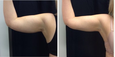 CoolSculpting before and after photo