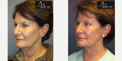 Facelift before and after photo