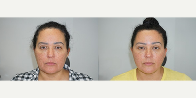 Facelift before and after photo