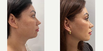 Facelift before and after photo