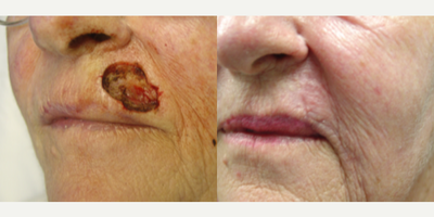 Mohs Surgery before and after photo