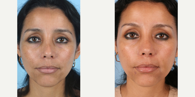 Revision Rhinoplasty before and after photo