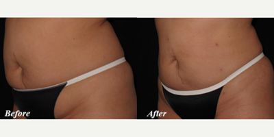 Smart Lipo before and after photo