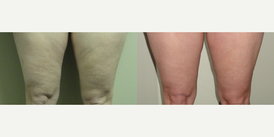 Venus Legacy before and after photo