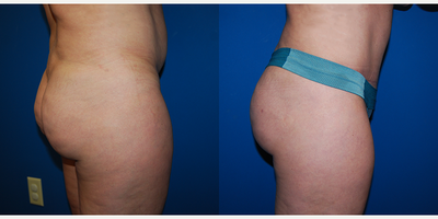 Brazilian Butt Lift before and after photo