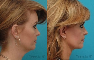 Facelift before and after photo