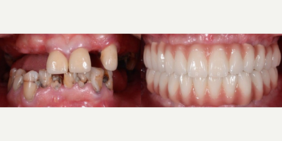 Full Mouth Reconstruction before and after photo