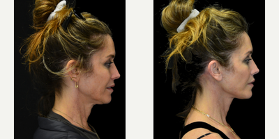 Mini Facelift before and after photo
