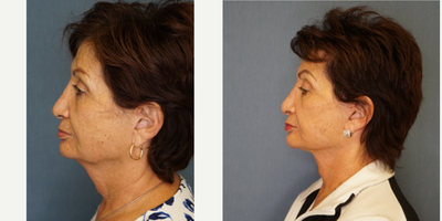 Neck Lift before and after photo