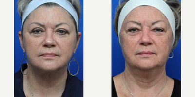 Neck Lift before and after photo