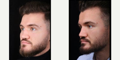 Revision Rhinoplasty before and after photo