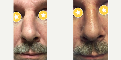 Rhinoplasty before and after photo