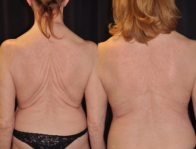 Body Lift before and after photo