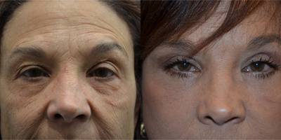 Eyelid Surgery before and after photo