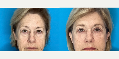 Eyelid Surgery before and after photo