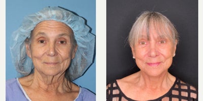 Facial Fat Transfer before and after photo