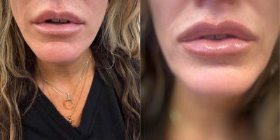 Lip Fillers before and after photo