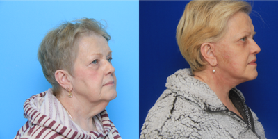 Neck Lift before and after photo