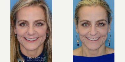 Rhinoplasty before and after photo