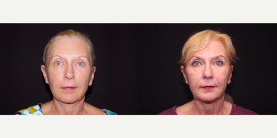 before and after image