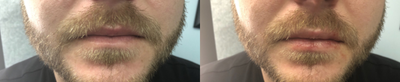 Juvederm before and after photo