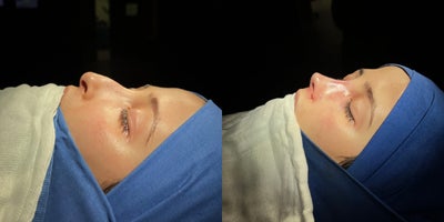 Rhinoplasty before and after photo