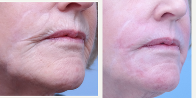 CO2 Laser before and after photo