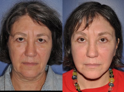 Deep Plane Facelift before and after photo