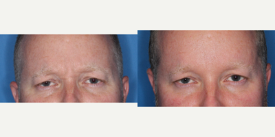 Dysport before and after photo