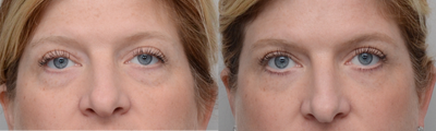 Eyelid Surgery before and after photo