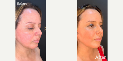 Facelift before and after photo