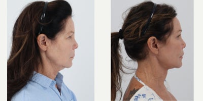 Facial Fat Transfer before and after photo