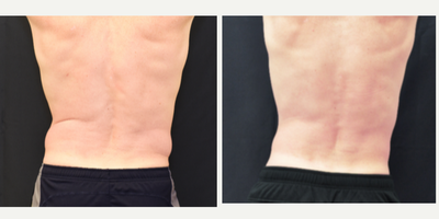 SculpSure before and after photo