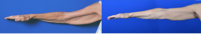 Arm Lift before and after photo