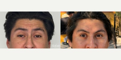 Botox before and after photo