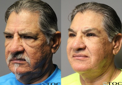 Neck Lift before and after photo