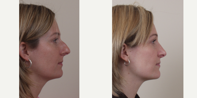Rhinoplasty before and after photo