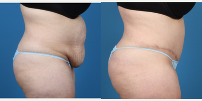 Tummy Tuck before and after photo